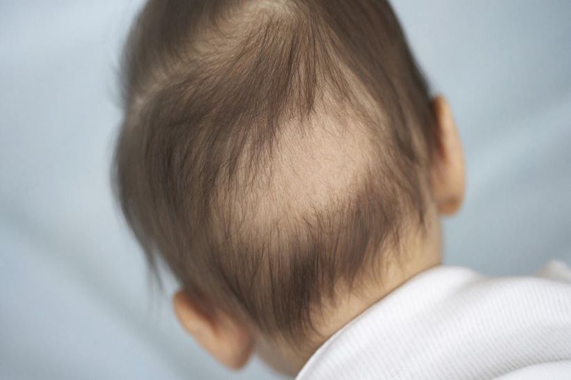 ksp-hair loss in kids- insta to website